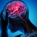تحریک نخاع به بازیابی قدرت بازو پس از سکته مغزی کمک می کند تحریک نخاع به بازیابی قدرت بازو پس از سکته مغزی کمک می کند