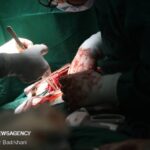 تشریح مهم ترین چالش های پیوند ریه در ایران تشریح مهم ترین چالش های پیوند ریه در ایران